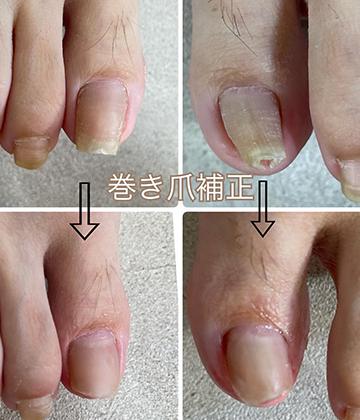 巻き爪補正サンプル02